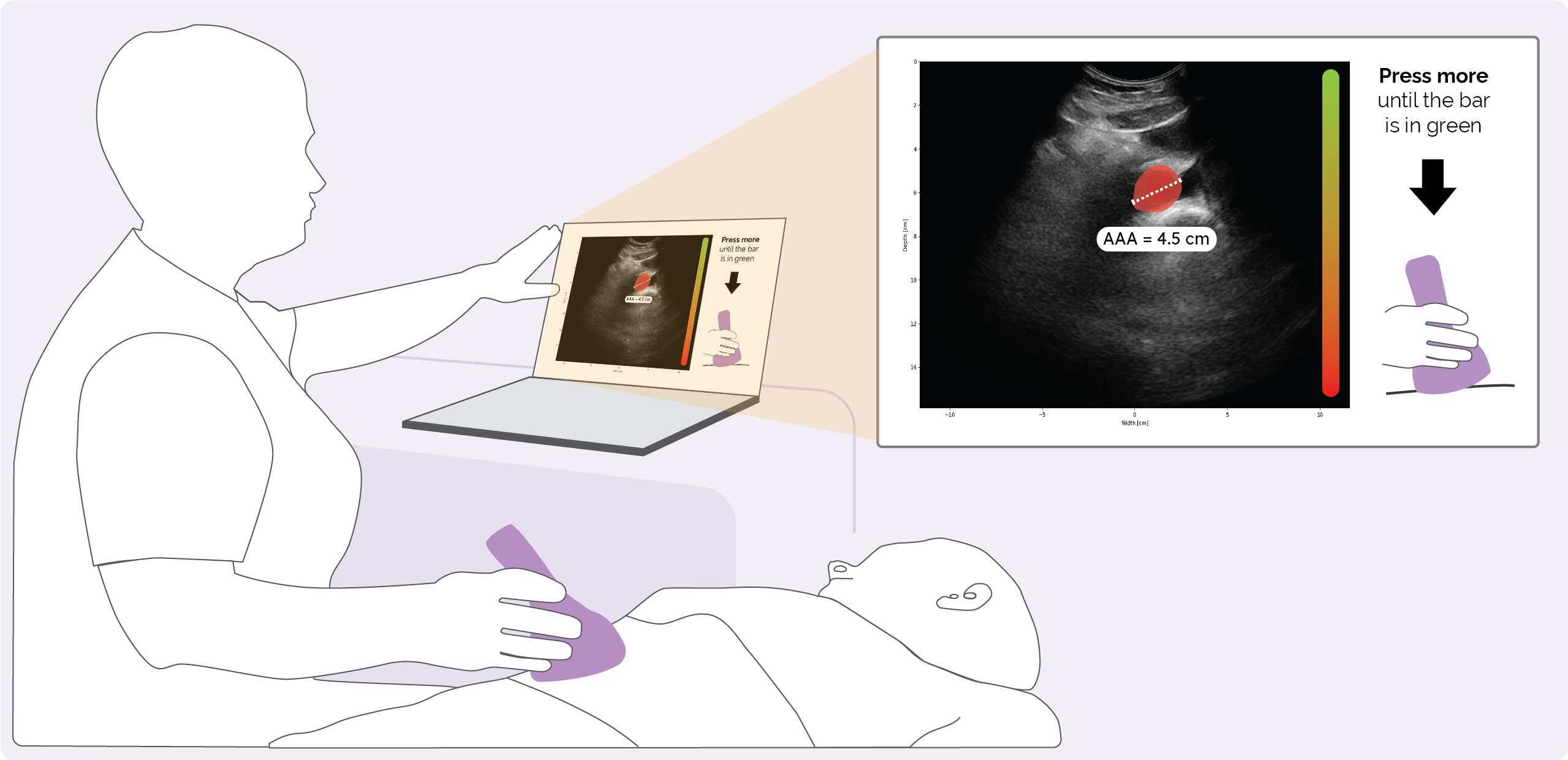 AI POCUS AAA – Kunstig intelligensveiledet ultralyd av hovedpulsåren i rurale områder